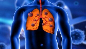 کشف دارویی که پیشرفت سرطان ریه را متوقف می‌کند