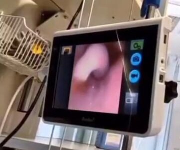 خارج کردن دندان بدون عمل جراحی در بیمارستان کوثر سنندج+ فیلم