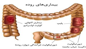 همه چیز درباره بیماری سندرم روده تحریک پذیر!