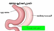 تجربیات افرادی که عمل اسلیو انجام داده اند