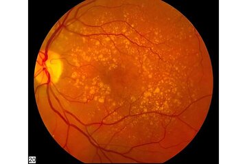مصرف «ملاتونین» احتمال بروز بیماری چشمی سالمندی را کاهش می‌دهد