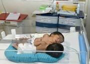 Conjoined twins separated in Shiraz hospital