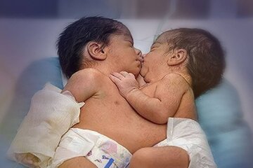 Successful separation operation of conjoined Iranian twins