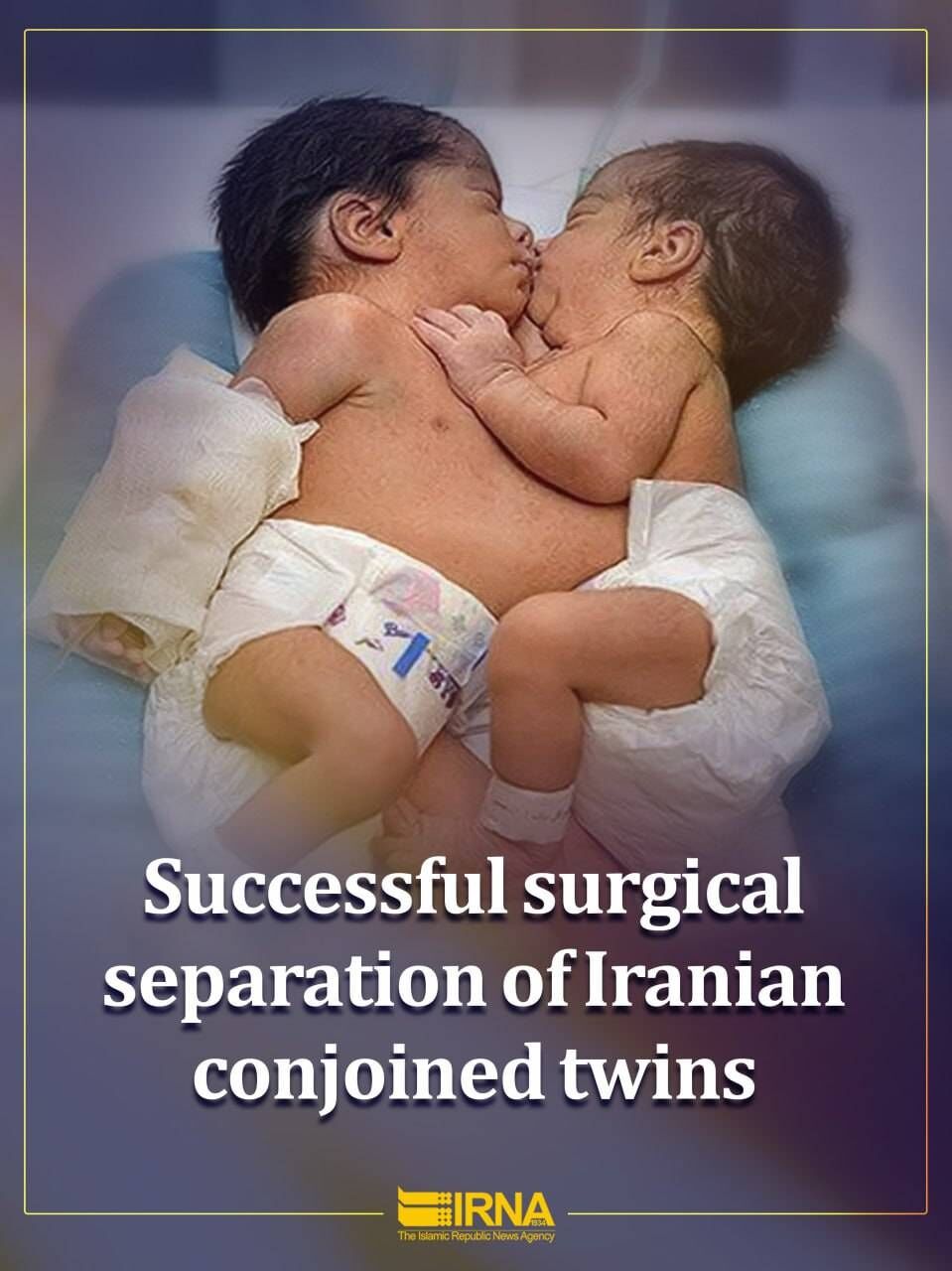 Successful separation operation of conjoined Iranian twins