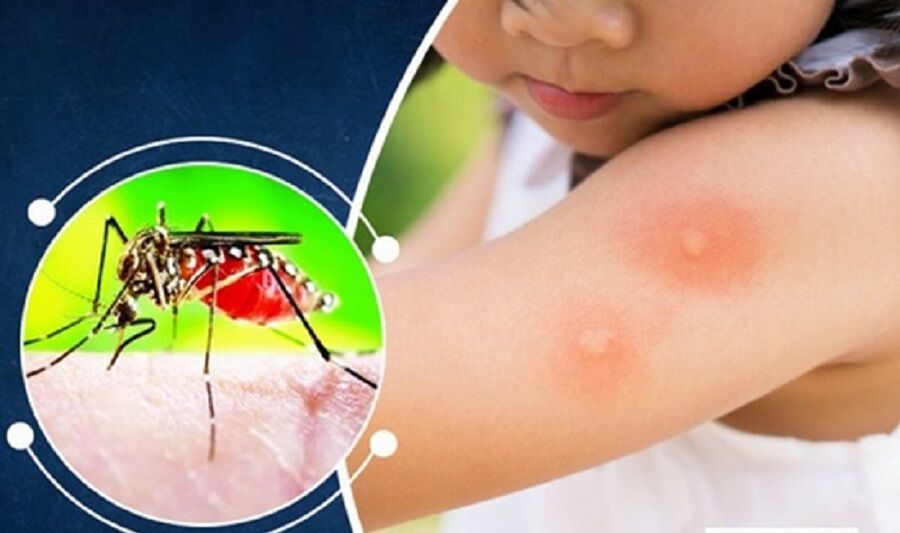 افراد علایم دار دارای پشه زدگی به مراکز درمانی مراجعه کنند افراد علایم دار دارای پشه زدگی به مراکز درمانی مراجعه کنند