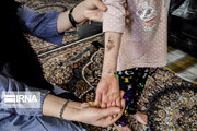 بٹر فلائی بیماری میں مبتلا بچوں کی مخصوص ڈریسنگ پر امریکی پابندی / 20 بیمار ایرانی بچے جان کی بازی ہار گئے