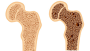 پوکی استخوان؛ شایع ترین بیماری متابولیک استخوان