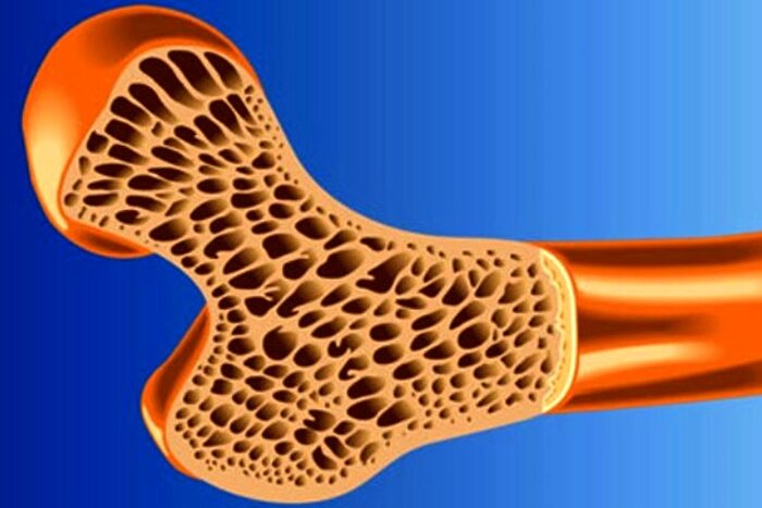 پوکی استخوان؛ شایع ترین بیماری متابولیک استخوان
