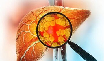 کبد چرب؛ علل، پیشگیری و درمان