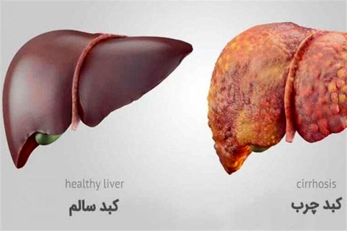 کبد چرب؛ بیماری خاموش قابل پیشگیری// کبد چرب؛ زنگ خطر سبک زندگی ناسالم