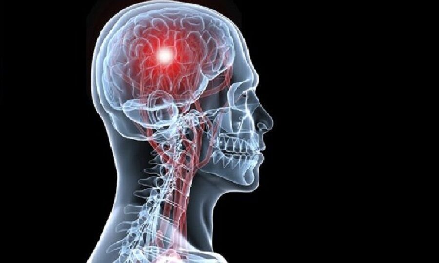 سکته مغزی؛ افزایش تصاعدی و چالش اطلاع رسانی سکته مغزی؛ افزایش تصاعدی و چالش اطلاع رسانی