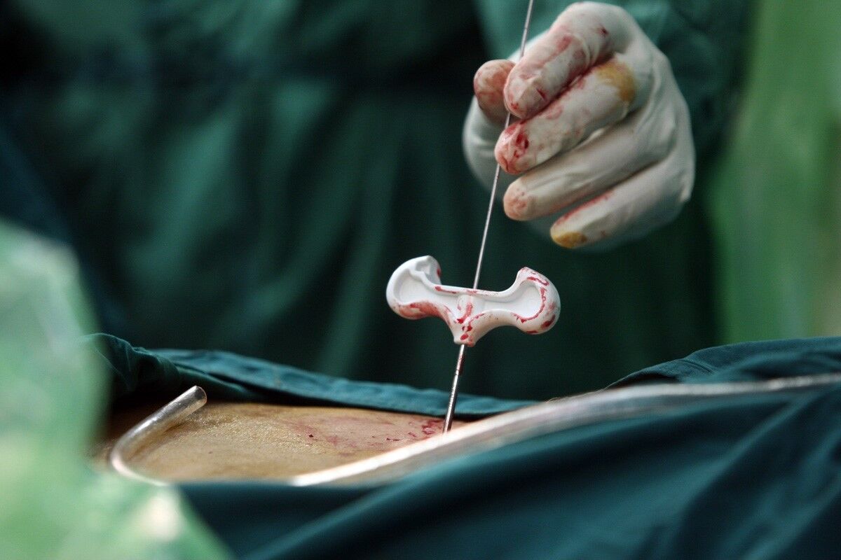 عمل موفقیت آمیز جراحی کمر در طبس عمل موفقیت آمیز جراحی کمر در طبس