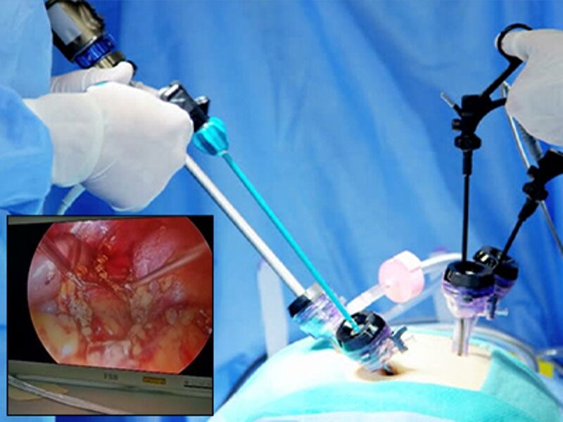 نخستین بار عمل جراحی آدرنالکتومی به روش لاپاراسکوپی در استان بوشهر انجام شد نخستین بار عمل جراحی آدرنالکتومی به روش لاپاراسکوپی در استان بوشهر انجام شد