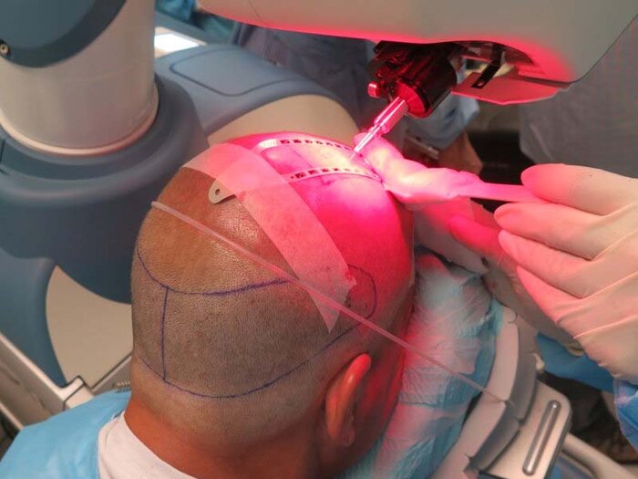 از باورهای غلط تا واقعیت علمی؛ آیا کاشت مو واقعا راه حل نهایی است؟