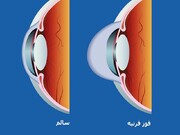 ارائه راهکارهای تشخیص زودهنگام بیماری قوزقرنیه بر پایه یادگیری ماشین