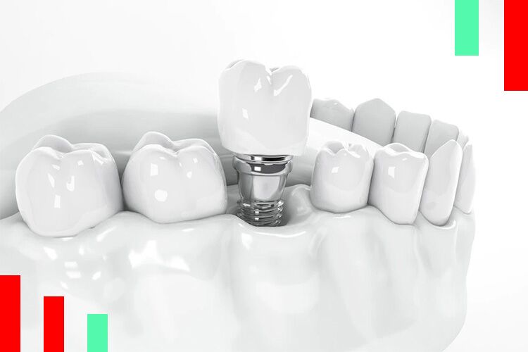 تاثیر دندانپزشک در موفقیت کاشت ایمپلنت دندان