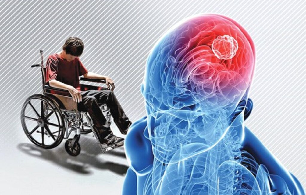 ام‌اس چیست و چه درمانی دارد؟