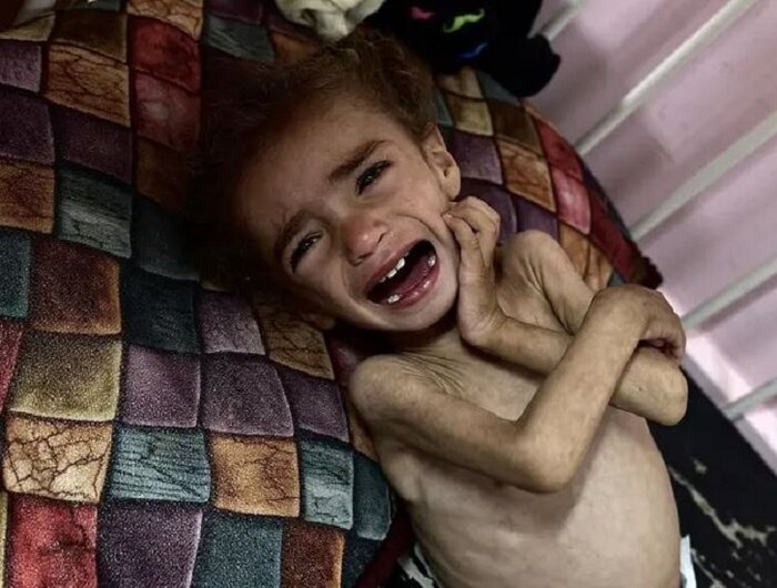 سوء تغذیه شدید ۴۰هزار کودک در نوار غزه/ تهدید زندگی معلولان