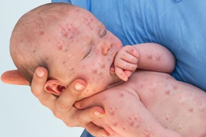 فوق تخصص بیماری‌های عفونی: واکسن موثرترین روش برای پیشگیری از سرخک است