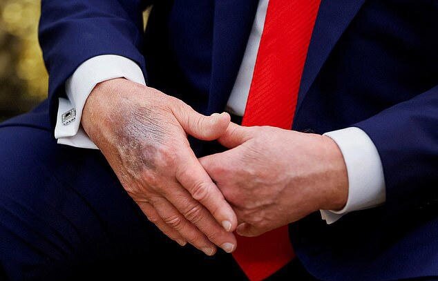 ترامپ؛ از نارسایی وریدی تا شایعه مرگ