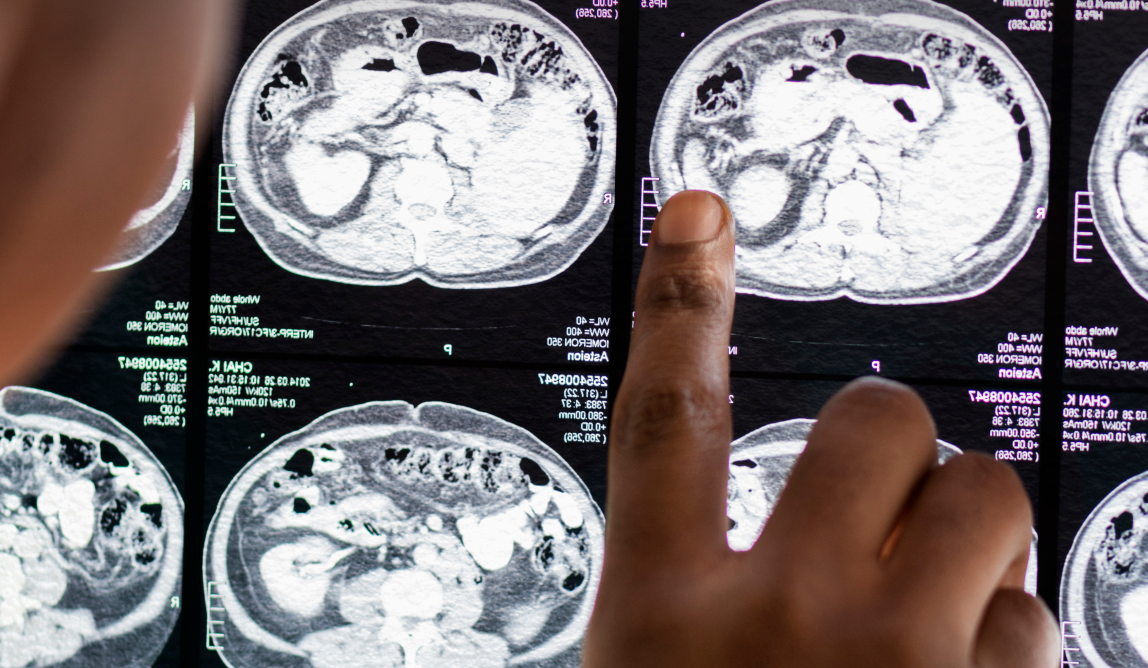 تشخیص بیماریهای مغزی با ارتقای تصویربرداری ام آر آی توسط هوش مصنوعی