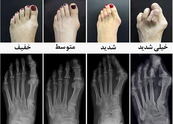 راهکارهایی ساده برای اصلاح انگشتان پا