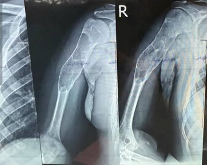 پیوند موفقت‌آمیز استخوان مصنوعی بازو در پارس‌آباد