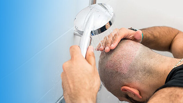 از باورهای غلط تا واقعیت علمی؛ آیا کاشت مو واقعا راه حل نهایی است؟