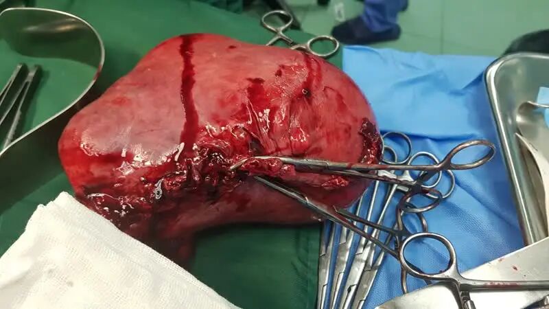 جراحی موفقیت‌آمیز برداشتن توده ۲ کیلویی در قم