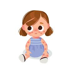 چرا اگزما اغلب در کودکی شروع میشود؟