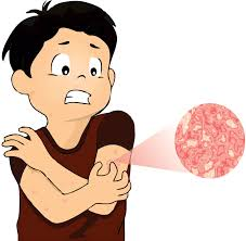 چرا اگزما اغلب در کودکی شروع میشود؟