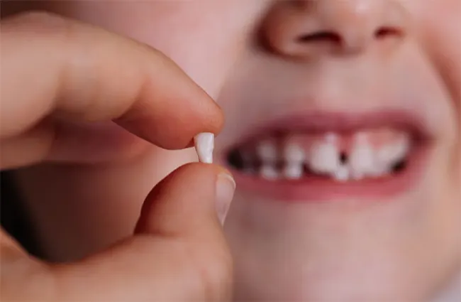 مراقبت از دندانهای شیری و دائمی کودکان پس از ضربه