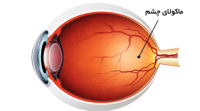 دژنراسیون ماکولا و نبرد آرام سالمندان با تاری دید
