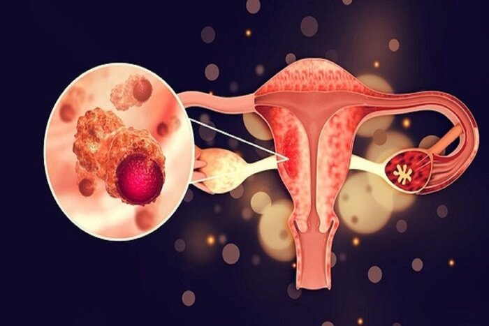 تشخیص دیرهنگام آندومتریوز؛ تهدیدی برای باروری زنان