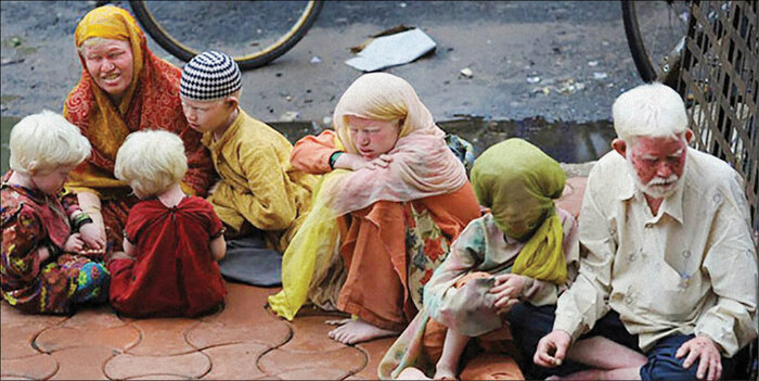سفیدتر از رنگها؛ روایت زندگی با زالی در سایه ناآگاهی و تبعیض