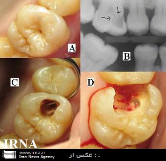 مصرف ميوه جات تازه در كاهش پوسيدگي دندان موثر است