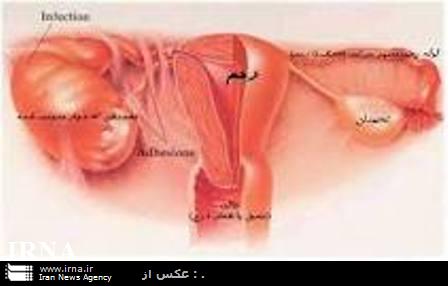 برنامه غذايي صحيح در كنترل سندرم تخمدان پلي كيستيك بسيار موثر است