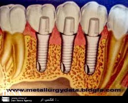 كاشت دندان جايگزين در كمتر از يك ساعت