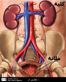 سرطان مثانه ، شايع ترين بيماري دستگاه مجاري ادرار است