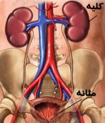 سرطان مثانه ، شايع ترين بيماري دستگاه مجاري ادرار است