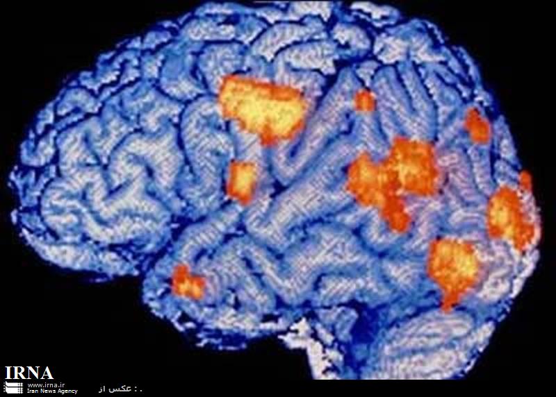 سردردهاي مداوم از نشانه هاي تومور مغزي در بزرگسالان است