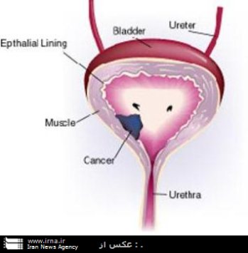 ميزان سرطان پروستات در ايران 9 تا 10 نفر در يكهزار است