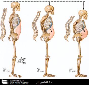 افراد بالاي 30 سال، پوكي استخوان را جدي بگيرند