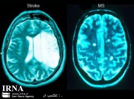 كشف روش جديدي براي درمان ام.اس