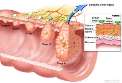 تشخيص سرطان روده بزرگ در مراحل اوليه