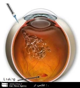 تزريق داخل چشمي روش جديد درمان رتينوپاتي ديابتي است