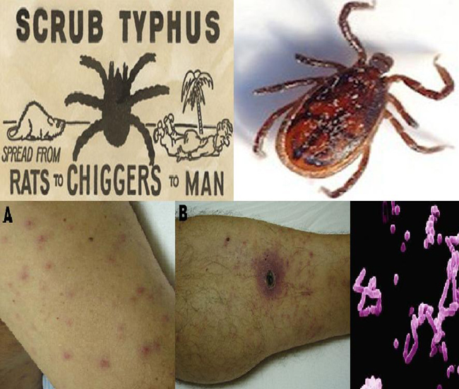 Mite-borne disease “Scrub typhus” claims 13 lives in India: Report