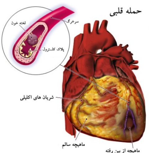 علايم هشدار حمله قلبي بدنتان را بشناسيد