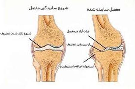 علائم آرتروز بعد از 40 سالگي  پديدار مي شود