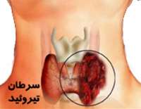 زنان اصفهانی رتبه اول ابتلا به سرطان تیروئید را دارند